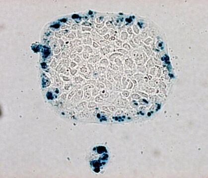 Eine mikroskopische Aufnahme von Krebszellen.