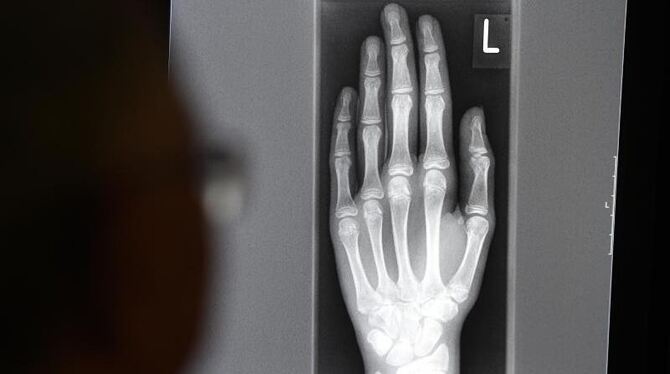 Über die radiologische Untersuchung des Handwurzelknochens und der Hand lässt sich das etwaige Alter eines Menschen bestimmen