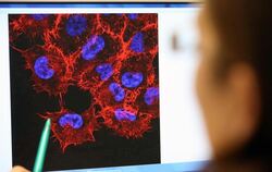 Monitorbild von Melanom-Zellen (schwarzer Hautkrebs) im Labor des Instituts für Experimentelle Gentherapie und Tumorforschung