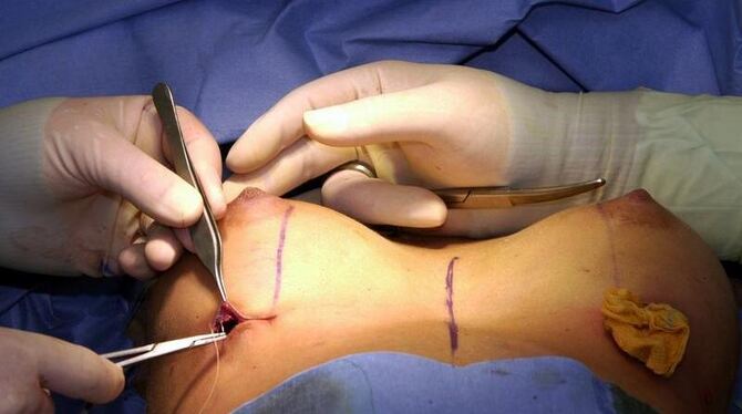 Bei einer Brustvergrößerung wird nach dem Einsetzen eines Silikon-Implantats der Schnitt zugenäht  Foto: Ulrich Perrey/ Archi