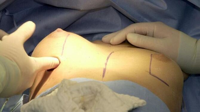 Operation zur Brustvergrößerung durch ein Silikon-Implantat. Foto: Ulrich Perrey