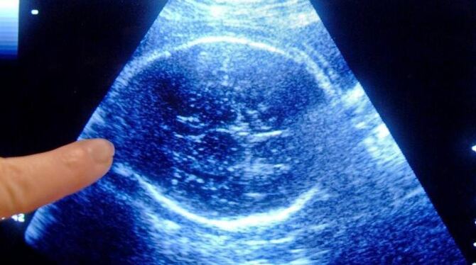 Fast alle Schwangerschaftsabbrüche in Deutschland werden nach der Beratungsregelung vorgenommen. Foto: Armin Weigel / Symbol
