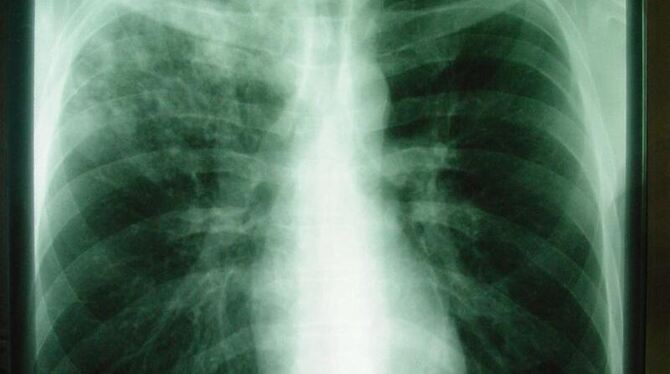 Das Röntgenbild zeigt eine offene Tuberkulose. Foto: Robert-Koch-Klinik Leipzig 