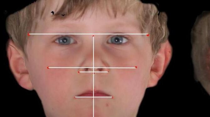 Die Messmethode, dargestellt am Gesicht des vierjährigen Niklas. Röntgenstrahlenfrei wird das Gesicht vermessen. FOTO: UKT