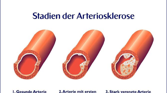 Arteriosklerose: Beim Medizinforum wird dieses Thema intensiv behandelt. FOTO: DPA