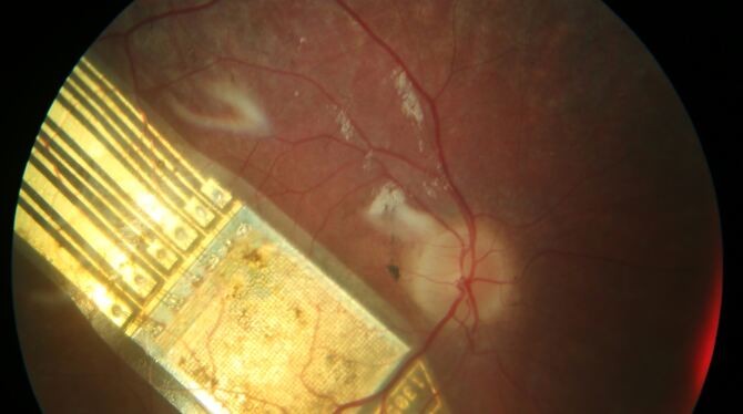 Patienten, die an der erblichen Augenkrankheit Retinitis pigmentosa erkrankt und in der Folge erblindet sind, konnten über einen