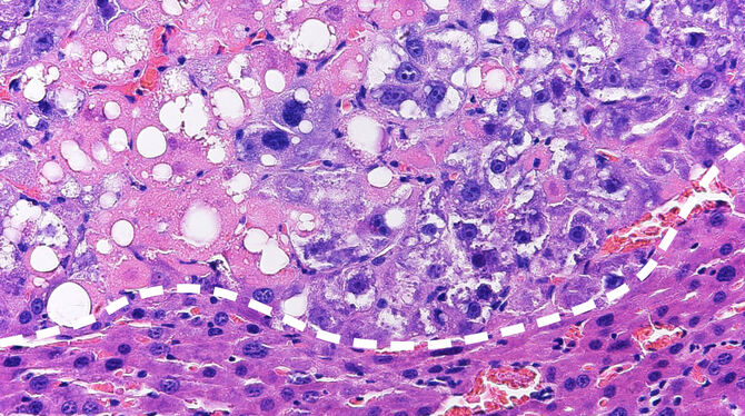 Ein Lebertumor unter dem Mikroskop: Während die Tumorzellen (oben) durch die lipotoxische Therapie stark angegriffen werden (es Ein Lebertumor unter dem Mikroskop: Während die Tumorzellen (oben) durch die lipotoxische Therapie stark angegriffen werden (es