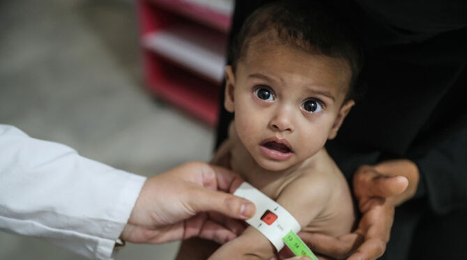 Ein syrisches Kind wird im Ibn-Sina-Krankenhaus aufgrund von Unterernährung medizinisch behandelt. Die Welthungerhilfe hat vor e