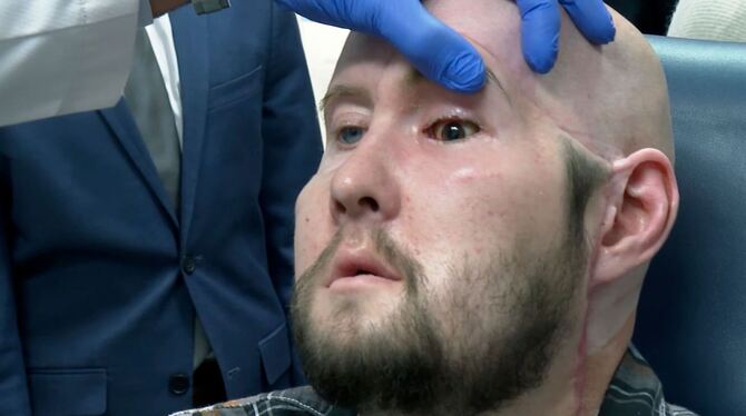 US-Chirurgen transplantieren vollständiges Auge