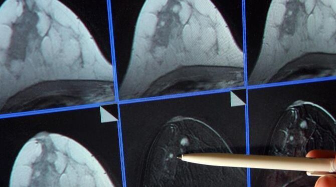 Auf der Bildschirmdarstellung einer Magnetresonanz-Mammographie ist ein winziger Tumor in einer Brust zu sehen. Foto: Jan-Pet