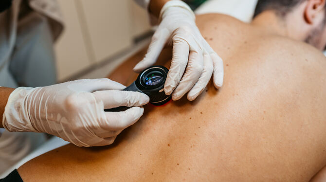 Das Hautkrebs-Screening wird Erwachsenen ab 35 Jahren alle zwei Jahre angeboten.