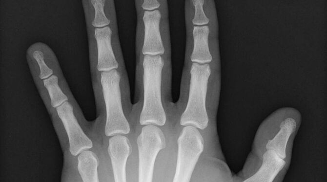 Die Röntgenaufnahme zeigt die Hand von Steffen Fröschle aus Ostfildern mit dem implantierten RFID-Chip. FOTO: PRIVAT